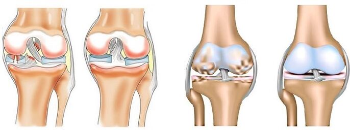 Was ist Arthritis und Arthrose 